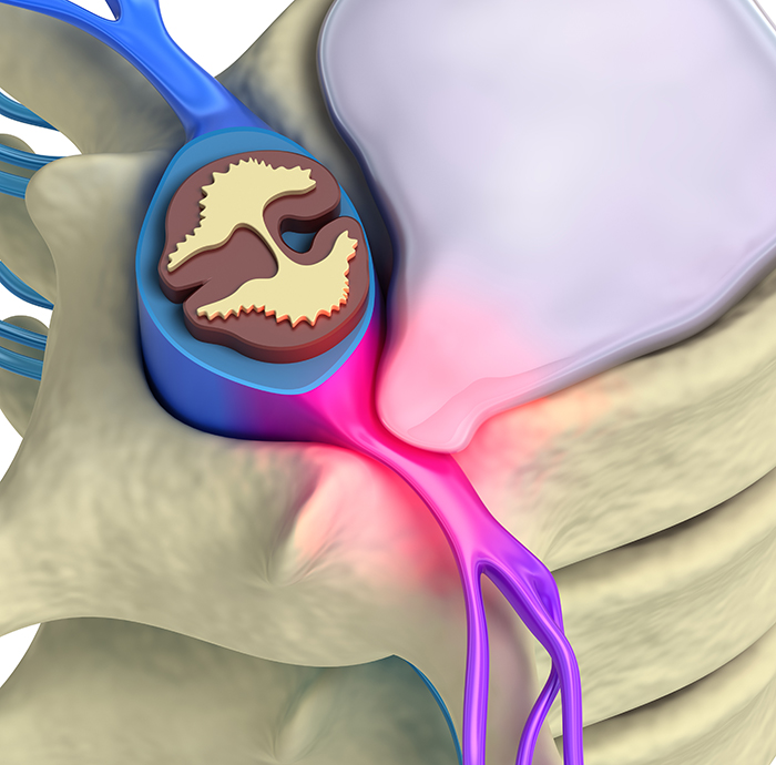 disc herniation