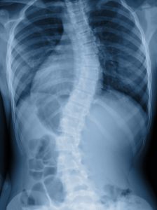 Scoliosis_chiropractic treatment_OH