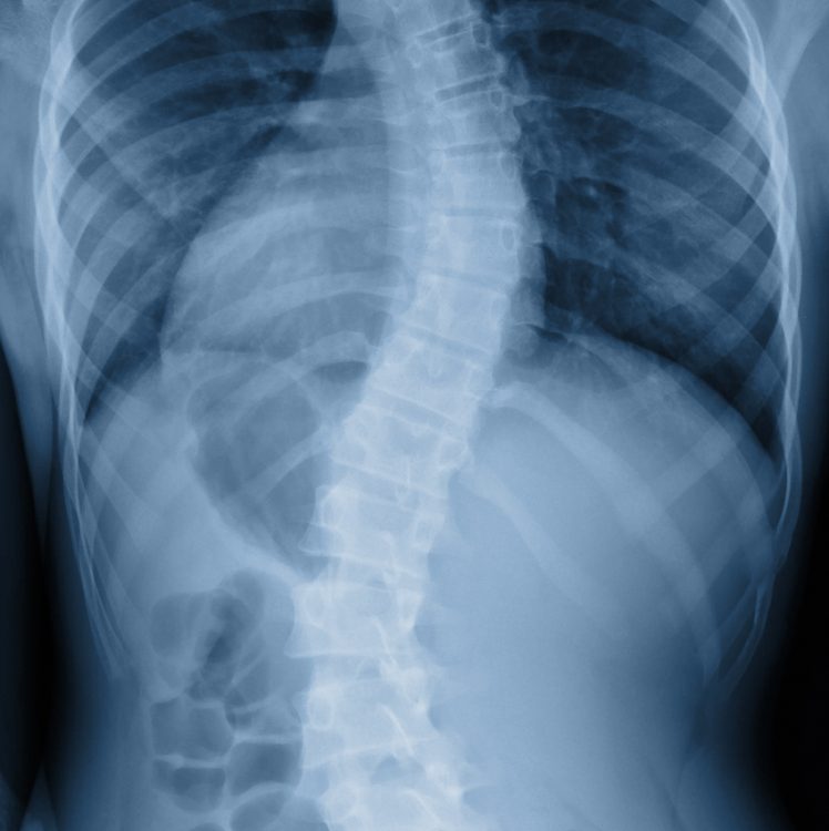 chiropractic-treatment-for-scoliosis