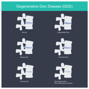 What Is Degenerative Disc Disease?