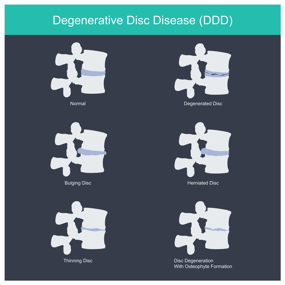 The Stages of Degenerative Disc Disease - N8 Family Chiropractic